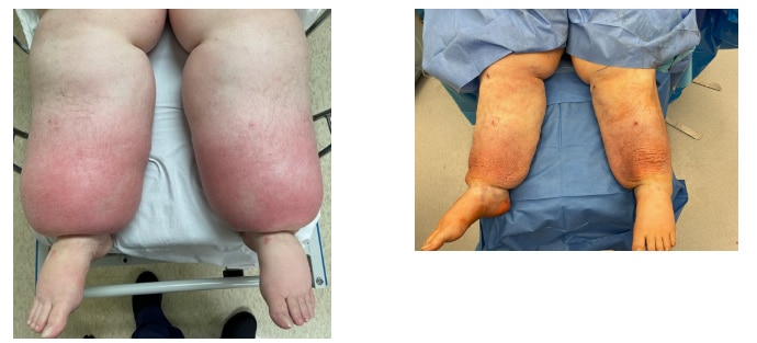 1769705280_l1 Lipedema Overview in West Long Branch, NJ