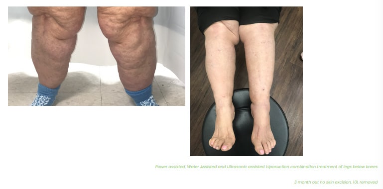 1769705291_l2 Lipedema Overview in West Long Branch, NJ