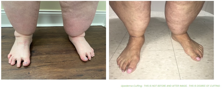 1769705302_l4 Lipedema Overview in West Long Branch, NJ