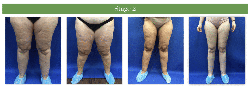 1769705511_56049ec0e0db4129b7ca1233bbd8236c Lipedema Overview in West Long Branch, NJ