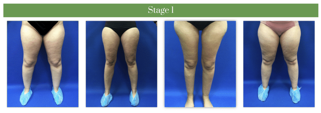 1769705523_2e0f27aa68f0464baa1b9b626a2401ce Lipedema Overview in West Long Branch, NJ