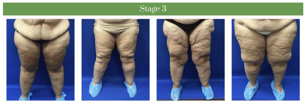 1769705533_112edea36ede495681ad832c3b3d8358 Lipedema Overview in West Long Branch, NJ