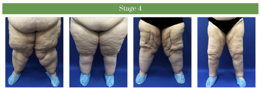 1769705544_4cfc51c719804a46874c1edaa42ad59d Lipedema Overview in West Long Branch, NJ