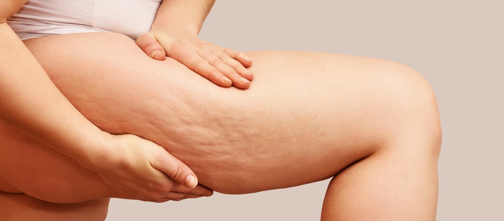 Cellulite,Leg,Woman,Pinch.,Test,Fat,Hips,Treatment.,Over,Weight