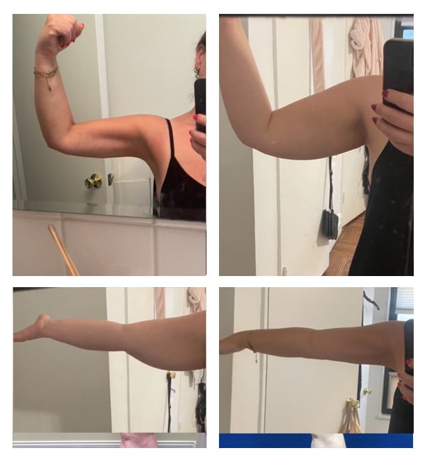 Before and After Image: Patient 10 - front