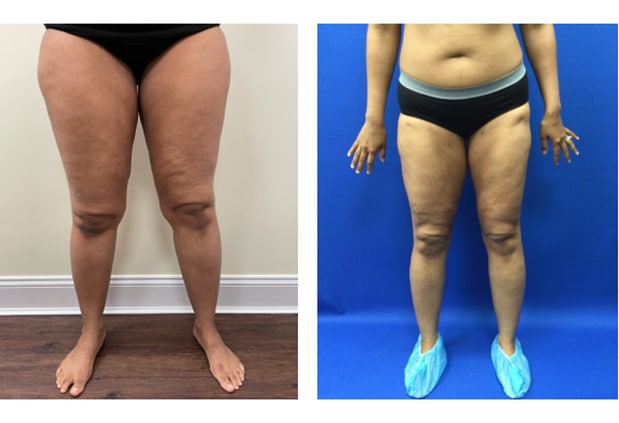 Before and After Image: Patient 11 - front