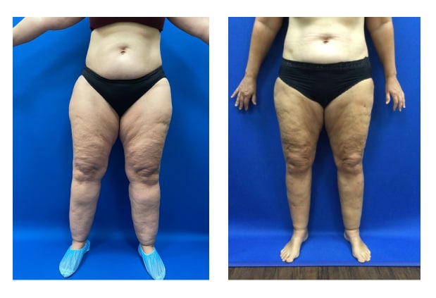 Before and After Image: Patient 5 - front