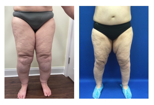 Before and After Image: Patient 6 - front