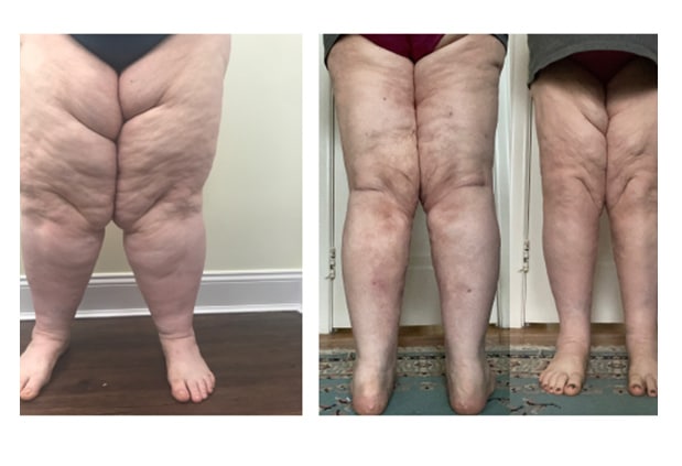 Before and After Image: Patient 8 - front