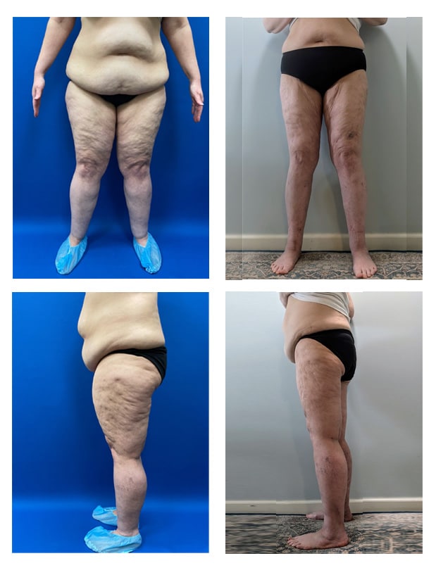 Before and After Image: Patient 9 - front