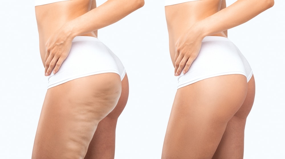 Before and after image of a woman receiving treatment for lipedema fat deposits in her legs and thighs.
