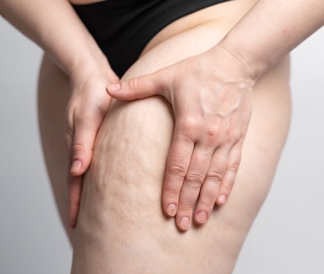 Patient squishing the excess fat deposits on her thigh, suffering from lipedema and in need of surgery.