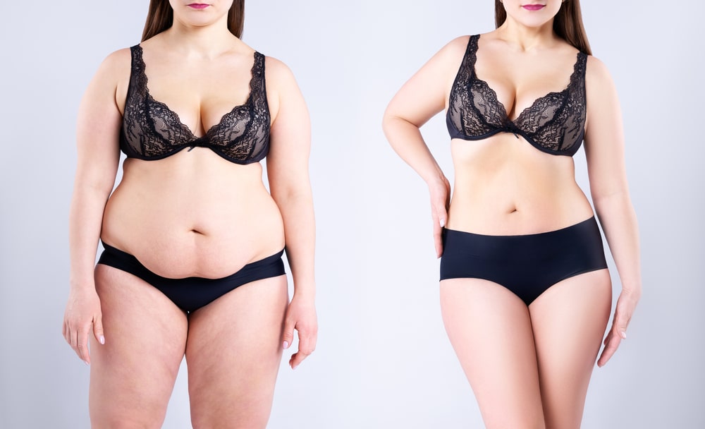 Woman who was suffering from abdominal lipedema and got treatment, before and after. Woman who was suffering from abdominal lipedema and got treatment, before and after.