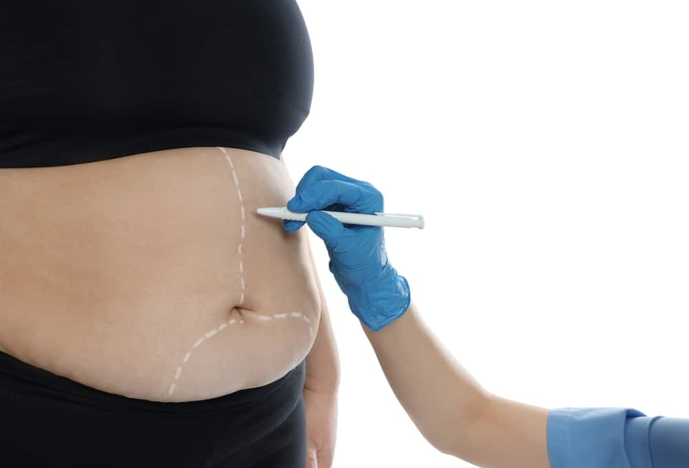 Patient having her stomach drawn on in preparation for a tummy tuck to target resistant lipedema fat. Patient having her stomach drawn on in preparation for a tummy tuck to target resistant lipedema fat.